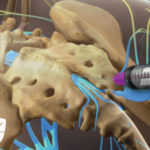 Caudal Epidural Steroid Injection Caudal Epidural Steroid Injection