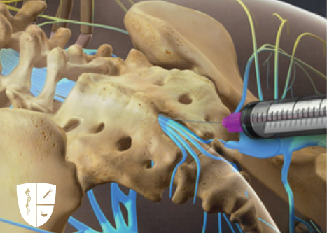 Caudal Epidural Steroid Injection