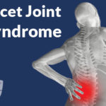 Facet Joint Syndrome Facet Joint Syndrome