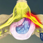 Herniated Disc (Cervical) Herniated Disc (Cervical)