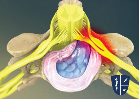 Cervical Epidural Steroid Injection