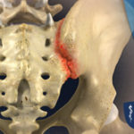 Sacroiliac Joint Steroid Injection Sacroiliac Joint Steroid Injection