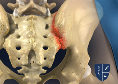 Sacroiliac Joint Steroid Injection